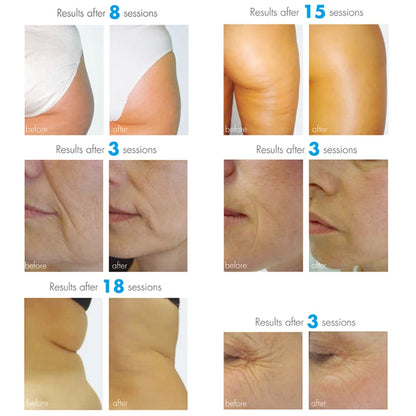 Body Roller Endoroller Device for Body Sculpting Buttock Toning Micro Vibration Roller Massage Lymphatic Drainage Therapy